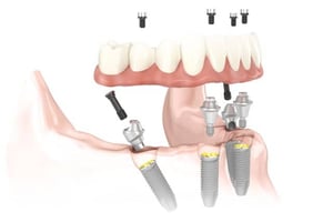 Diagramma 3D che mostra il concetto All-on-4®: una protesi dentale fissa viene posizionata su quattro impianti inclinati e due posteriori verticali, completata con abutment e viti di fissaggio