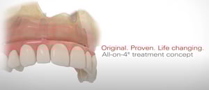 Riabilitazione dentale All-on-4® con protesi fissa supportata da 4 impianti a Lugano