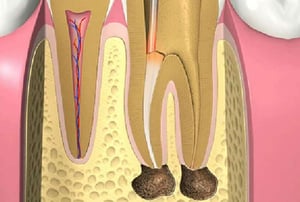 Illustrazione di un dente con infezione alla radice