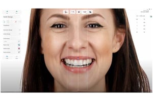 Esempio di Digital Smile Design: simulazione digitale del sorriso su fotografia del paziente con software odontoiatrico