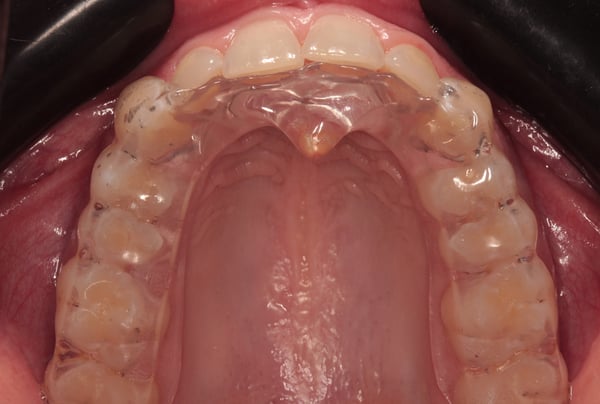 Fotografia intraorale che mostra un bite trasparente posizionato sull’arcata superiore, utilizzato per proteggere i denti e ridurre gli effetti del serramento dentale