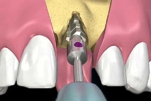 Illustrazione digitale di preparazione ossea per impianto dentale nella zona frontale superiore.
