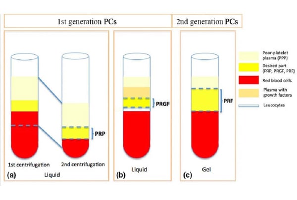 Schema comparativo dei concentrati piastrinici di 1ª e 2ª generazione (PRP, PRGF, PRF) con fasi di centrifugazione e stratificazione di plasma, fattori di crescita, globuli rossi e leucociti
