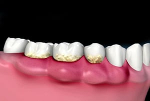 Accumulo di placca e tartaro sui denti e gengive infiammate prima della levigatura radicolare