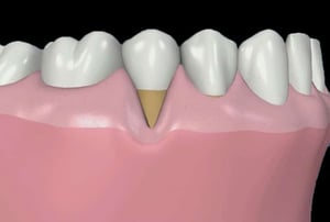 Recessione gengivale con radice dentale esposta prima di intervento di chirurgia mucogengivale.