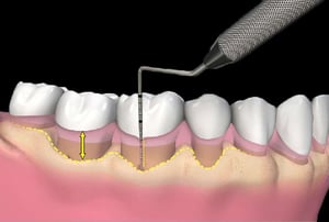 Visualizzazione della perdita di supporto osseo nei denti colpiti da parodontite.