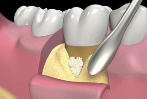 Inserimento di biomateriale osseo durante chirurgia rigenerativa parodontale.