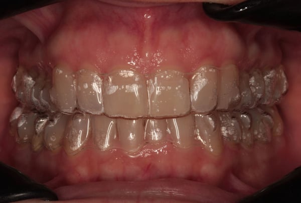 Vista frontale dell’arcata superiore e inferiore con allineatori trasparenti indossati su entrambi gli archi dentali, evidenziando l’aderenza e la simmetria del trattamento ortodontico invisibile.