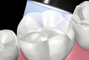 Fotopolimerizzazione: applicazione della luce per indurire il materiale composito