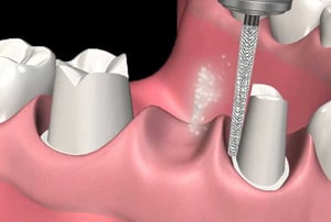 Preparazione dei monconi dentali per protesi fissa, con rifinitura tramite fresa odontoiatrica