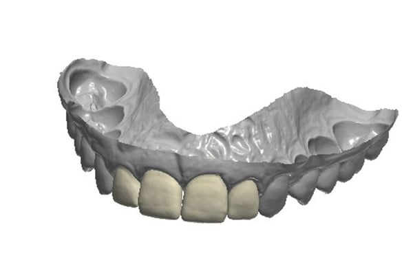 Modello digitale 3D dell’arcata dentale superiore con evidenziati in colore chiaro gli incisivi e canini anteriori