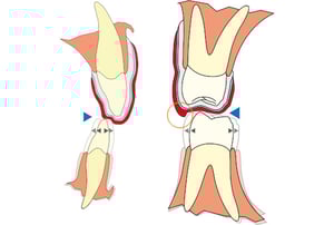 Illustrazione odontoiatrica che mostra un dente incluso o in posizione errata che spinge contro il dente adiacente, evidenziando la pressione esercitata e il potenziale riassorbimento radicolare.