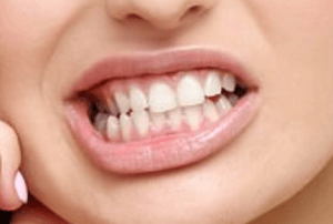 Donna che serra i denti mostrando tensione mandibolare, immagine rappresentativa del serramento dentale e dei disturbi legati all’occlusione.