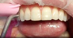 Fotografia ravvicinata di un’arcata superiore durante una seduta odontoiatrica, con utilizzo di uno strumento Air Prophy per la pulizia e la rimozione di macchie superficiali dai denti anteriori.