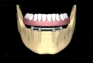 Barra metallica fissata a quattro impianti dentali nella mandibola