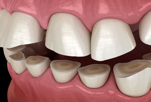 Illustrazione che rappresenta denti consumati da serramento e bruxismo