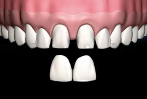 Prova della faccetta dentale – verifica della forma e del colore prima della cementazione definitiva.