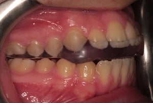 Fotografia intraorale che mostra un bite trasparente utilizzato per proteggere i denti e ridurre gli effetti del serramento dentale.