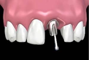 Vista frontale intraorale dell’innesto di un moncone implantare (abutment) su impianto dentale nella mascella anteriore, con attrezzo odontoiatrico in fase di avvitamento.