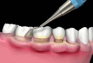 Strumento professionale (detartratore ultrasonico) utilizzato per la rimozione di tartaro e placca sottogengivale dai denti, illustrato in una vista laterale dell’arcata dentale.