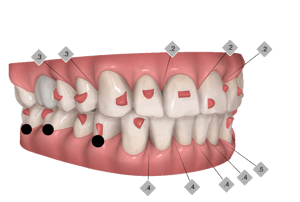 Illustrazione 3D di trattamento di ortodonzia invisibile: modifiche dentali pianificate con indicatori numerici (thickness remotion, spostamenti), su arcata superiore e inferiore in visuale laterale