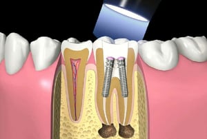 Sezione dillustrazione odontoiatrica di una ricostruzione preprotesica con trattamento canalare e perno endocanalareel dente con impianti endodontici e innesto osseo