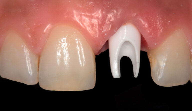 Corona in zirconia-ceramica su impianto