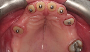 Perio-overdenture con cappe in composito