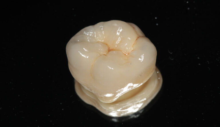 Corona dentale in zirconia-ceramica