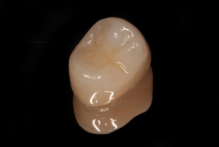 Corona in zirconia monolitica premolare