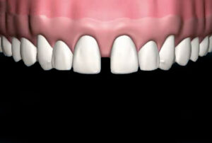 Veneers_01