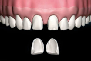 Veneers_05