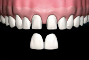 Veneers_06