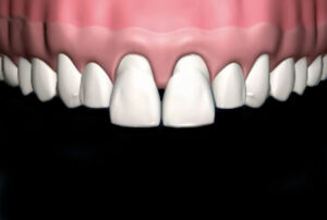 Veneers_07