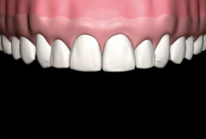 Veneers_08