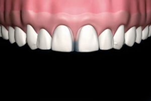 Veneers_09