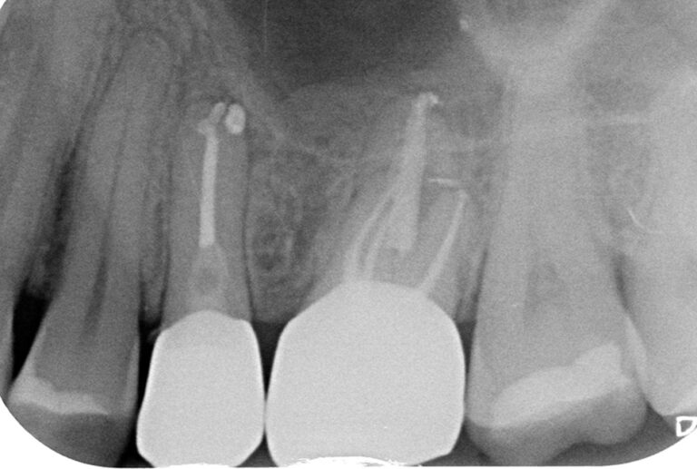 Ritrattamento endodontico e corone in zirconia