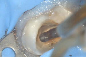 Ritrattamento endodontico al microscopio VIDEO