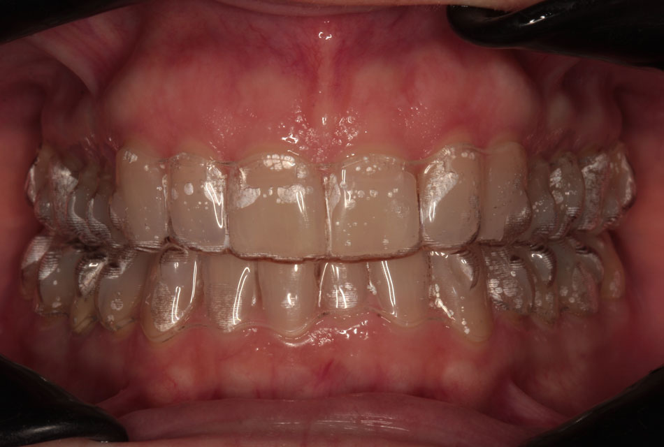 Ortodonzia Invisibile: Invisalign e F22 a Lugano